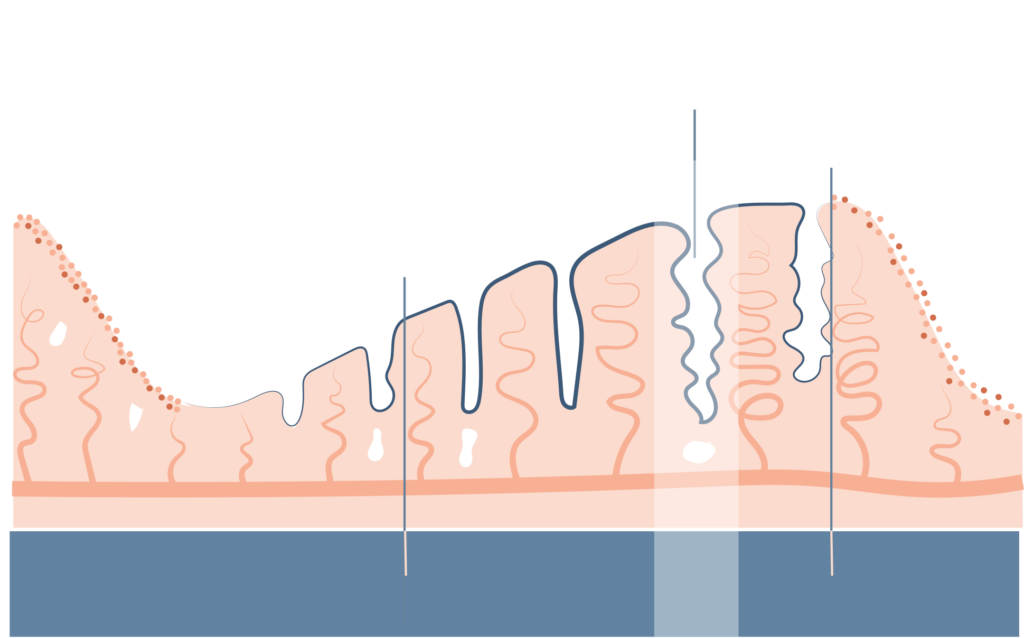 endometrio