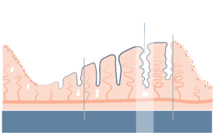 endometrio